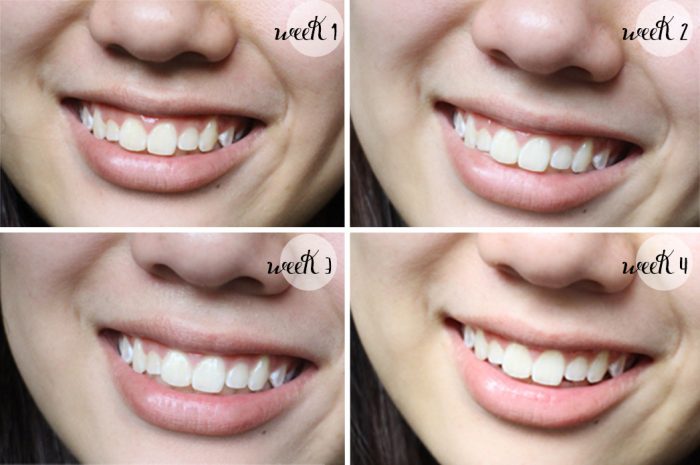 gel-lam-trang-rang-dr-haiian-proessional-clinic-11 gel-lam-trang-rang-dr-haiian-proessional-clinic-11
