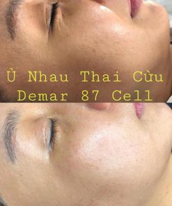 u trang mat nhau thai cuu demar87 cell 12