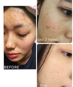 set tri mun skin proctor ac blemish resolver duo 6