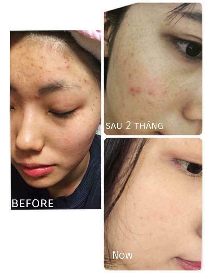 set tri mun skin proctor ac blemish resolver duo 6