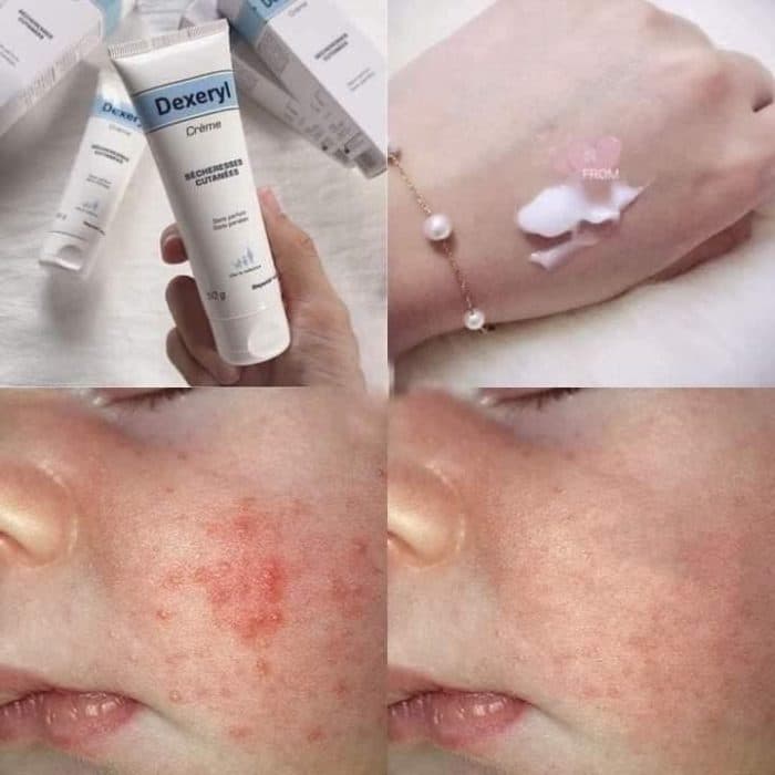 Kem Nẻ Dexeryl Creme Pháp Mẫu Mới