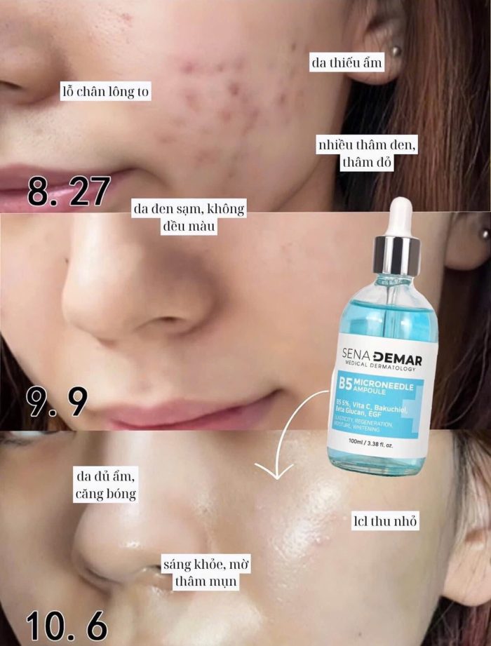 Serum Senademar B5 Microneedle Ampoule Cấp Ẩm