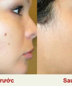 kem tri mun thit body tsubuporon night patch 20g 9